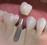 Quanto custa um implante dentario em 2025?