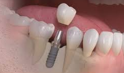 Quanto custa um implante dentario em 2025?