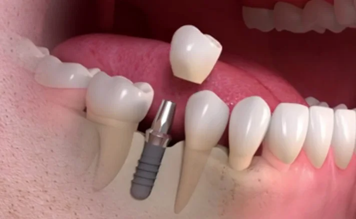 Imagem de implante dentário unitário